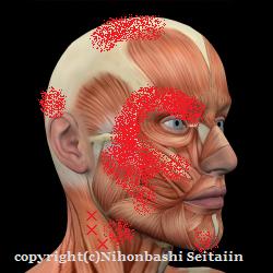 胸鎖乳突筋のトリガーポイントと放散痛の図説