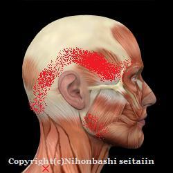 上僧帽筋のトリガーポイントと放散痛の図説