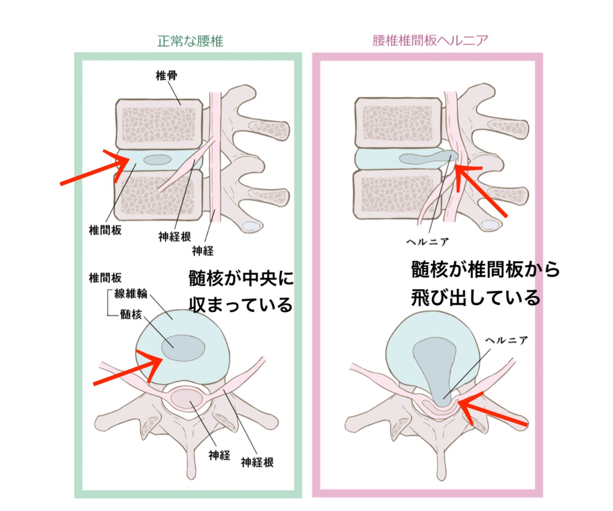 椎間板ヘルニアのイラスト
